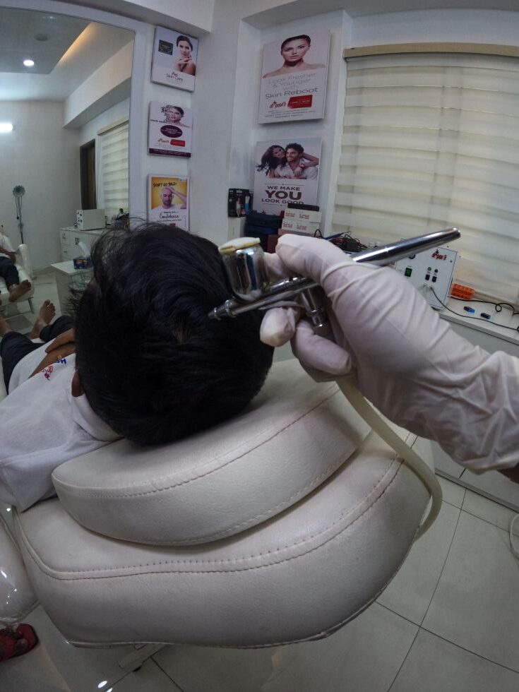 Baldness - Best Hair Loss Treatment
